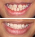 teeth_comparison